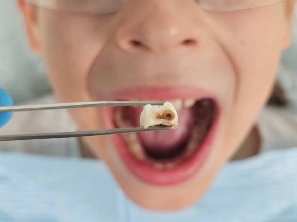 Best Emergency Tooth Extraction  in Calvert City, KY